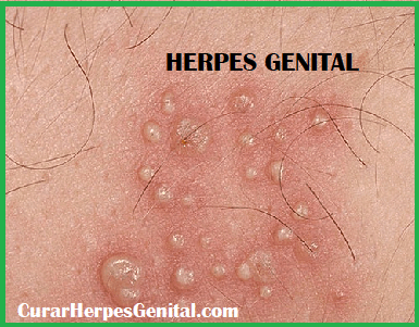 Herpes Genital, Granos o Espinillas Genitales?, Diferencias