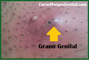 Herpes Genital, Granos o Espinillas Genitales?, Diferencias