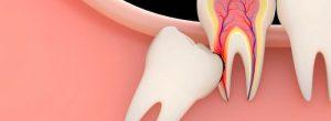 Infección de la muela de juicio (pericoronitis): ¿es hora de considerar la eliminación de la muela de juicio? 5 Consejos para prevenir la infección después de la eliminación de la muela de juicio