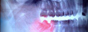 Infección de la muela de juicio (pericoronitis): ¿es hora de considerar la eliminación de la muela de juicio? Eliminación no quirúrgica de la muela de juicio: qué esperar y consejos para el cuidado posterior