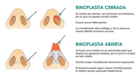 Rinoplastia, qué es y como se hace