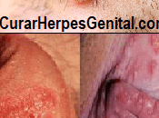 Remedios Naturales Para Herpes Labial Genital