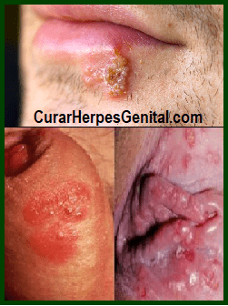 10 Remedios Naturales Para Herpes Labial y Genital