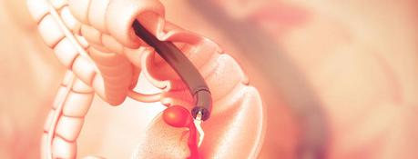 Razones de una colonoscopia