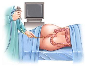 Colonoscopia: cómo se hace