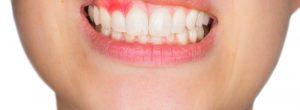 Reemplazo permanente del diente en pacientes con enfermedad de las encías