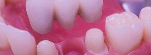 Reemplazo permanente del diente: diferentes técnicas utilizadas para puentes dentales