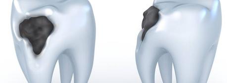 Caries Qué son las caries