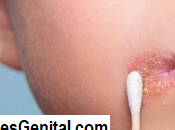 Herpes Labial Como Curarlo Para Siempre