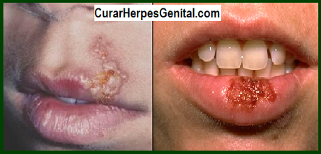 Herpes Labial Causas, Sintomas y Remedios