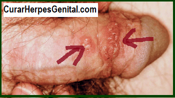 Como Tratar el Herpes Genital en Hombres