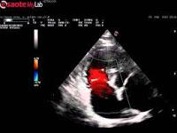 Implantan Sistema Pascal en un Paciente con Regurgitación Tricuspídea