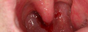 Bulto en la úvula: ¿causas?