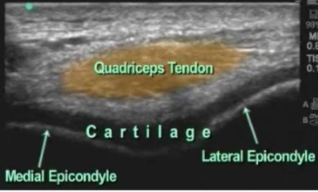 Ultrasonido de Rodilla Anatomía mas Patología