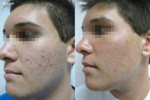 Como Me Quito El Acne Dela Cara Rapido – La Mejor Respuesta
