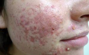 Como Desaparecer El Acne Del Rostro Con Exito Desde Hoy Como Desaparecer El Acne Del Rostro Con Exito Desde Hoy