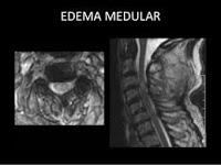 El Edema Medular en la Columna Vertebral es común en los Atletas