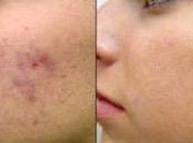 Como Limpiar Acne Rostro Forma Natural