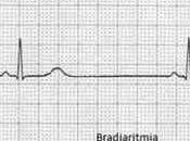Bradiarrítmia; causa fallecimiento Astolfi, jugador Fiorentina