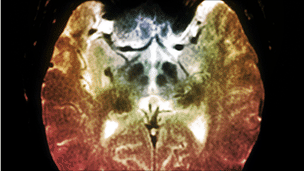 Gene therapy 'treats' Parkinson's disease