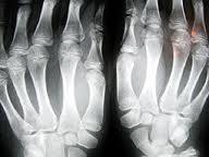 Enfermedades raras: mucopolisacaridosis, segunda parte