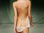 anorexia nerviosa