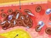 Prevenir arteriosclerosis forma natural