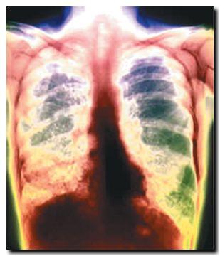 En Bolivia mueren entre 5 y 6 por día  de  tuberculosis