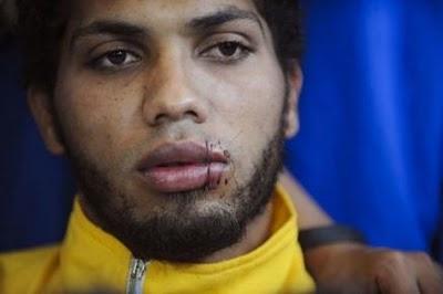 Venezolano se cose la boca en protesta por más presupuesto para universidades