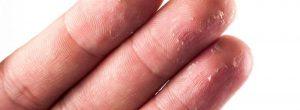 ¿Qué causa la descamación de la piel en las yemas de los dedos?