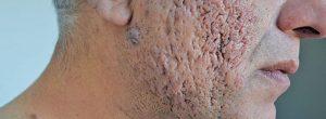 2 Desodorantes para usar si sufre de Hidradenitis Supurativa ¿Por qué su médico le recetó antidepresivos para tratar la Hidradenitis Supurativa?
