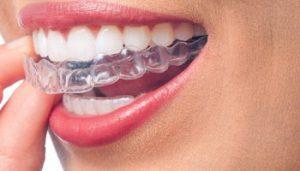 invisalign u ortodoncia invisible Dentistas en Madrid - Dental Denche