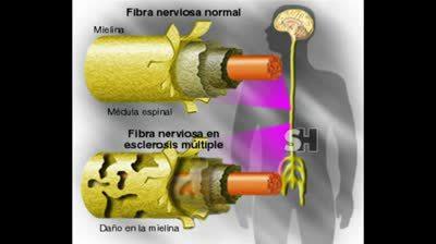 Las vesículas que favorecen la expansión del herpes