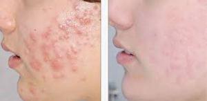 Cómo Quitar El Acné De La Cara Con Remedios Caseros? Cómo Quitar El Acné De La Cara Con Remedios Caseros?