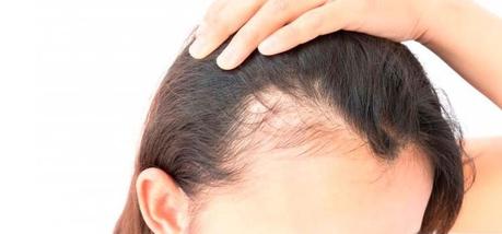 Alopecia en mujeres