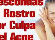 Cómo Combatir Acné Naturalmente Casa Mismo