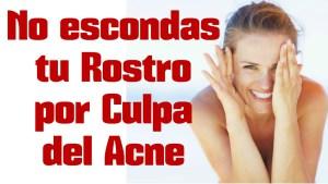 Cómo Combatir El Acné Naturalmente En Casa Ya Mismo