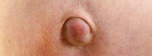 El dolor y la hinchazón justo arriba del ombligo generalmente se deben a una hernia umbilical