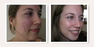 como curar el acne con remedios caseros Como Curar El Acne Con Remedios Caseros Seguros y Efectivos