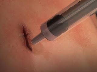 Pegamento quirúrgico que sella heridas en segundos.