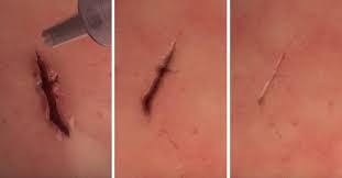 Pegamento quirúrgico que sella heridas en segundos. Pegamento quirúrgico que sella heridas en segundos.