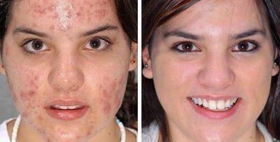 Como Disminuir El Acne En Cuatro Semanas o Menos