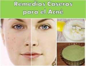 Como Deshacerse Del Acne Rapidamente – Una Guía Natural