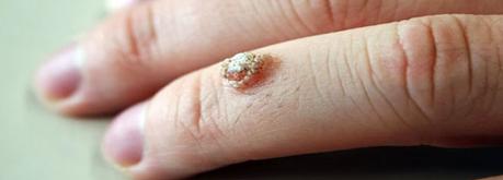 Nitrato de plata en verrugas