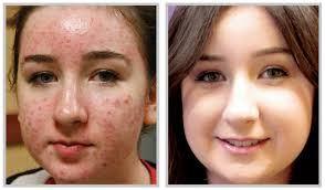 Que Hacer Para Eliminar El Acne Por Completo En 15 Dias
