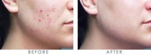 Como Se Puede Eliminar El Acne Cronico En Tres Pasos