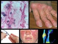 Identifican Nuevos Objetivos para Tratar las Enfermedades Autoinmunes