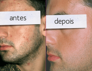 Como Eliminar El Acne Rapido Explicado Paso a Paso