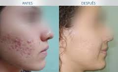 Como Eliminar El Acne Rapidamente De Forma Natural Como Eliminar El Acne Rapidamente De Forma Natural