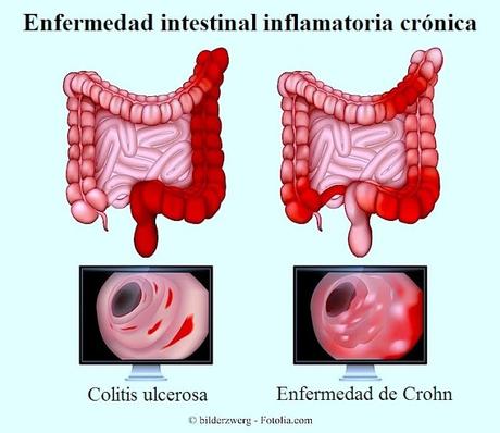 Tratamiento selectivo para pacientes con enfermedad inflamatoria intestinal